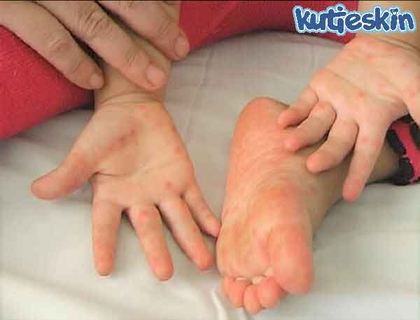 Trẻ bị mẩn ngứa ở chân tay: Bệnh chân tay miệng