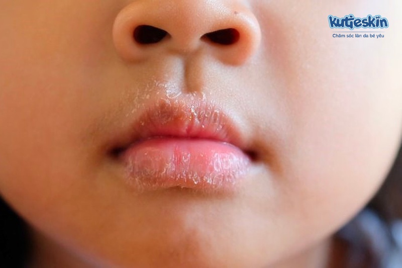 Nguyên nhân nào dẫn đến tình trạng bé bị nẻ môi?