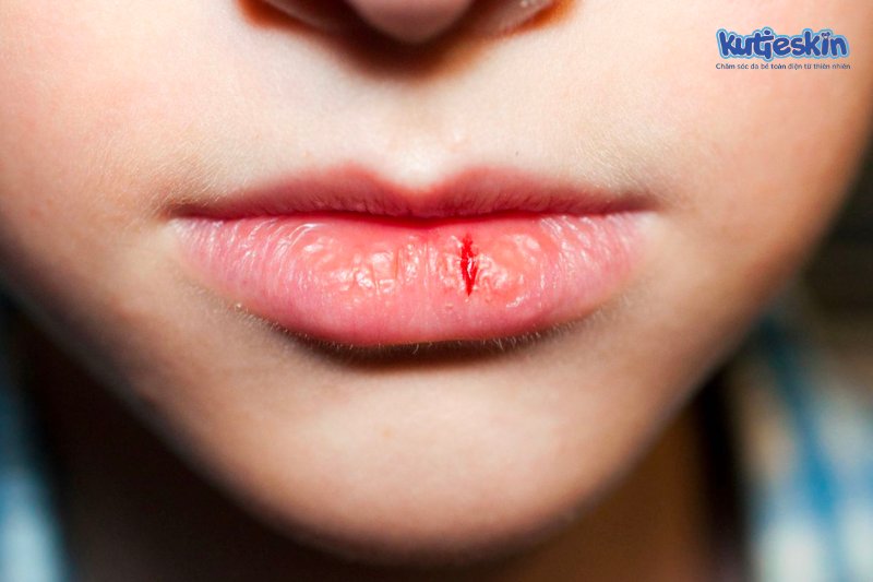 Nẻ môi là tình trạng da môi của bé bị khô ráp, bong tróc nặng, nứt nẻ