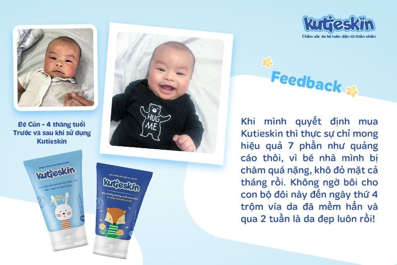 Kem dưỡng ẩm cho bé Kutieskin là sản phẩm được các chuyên gia đánh giá cao về hiệu quả và đảm bảo tiêu chí an toàn, lành tính khi sử dụng trên da của bé sơ sinh.
