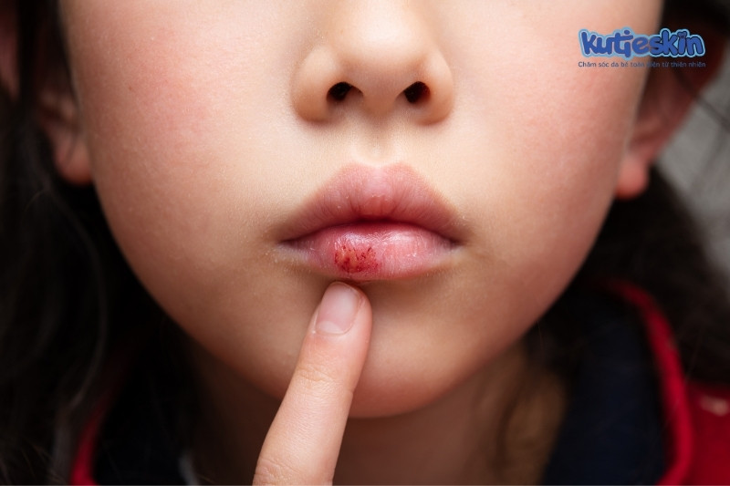 Bé bị nứt nẻ môi thường xuyên có phải là bệnh không?