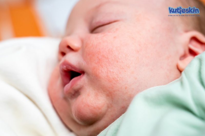Chàm sữa là căn bệnh viêm da cơ địa thường gặp ở trẻ sơ sinh