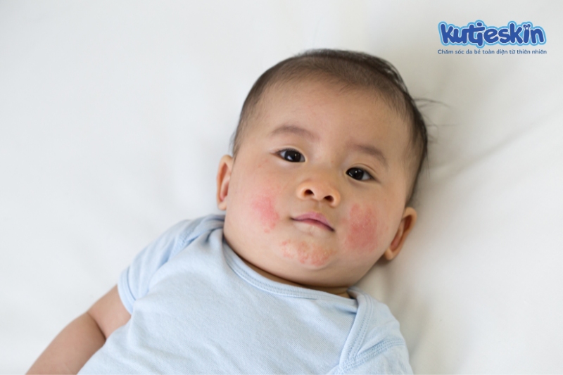 Chàm sữa là bệnh ngoài da thường gặp ở trẻ sơ sinh