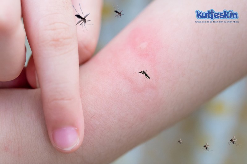 Bé bị muỗi đốt ngứa có thể mắc nhiều bệnh nguy hiểm