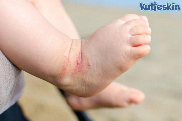 Trẻ bị mẩn ngứa ở chân và tay
