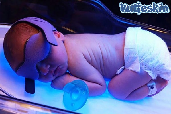 chiếu đèn chữa vàng da bệnh lý ở trẻ sơ sinh