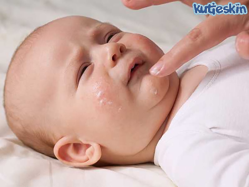 điều trị viêm da tụ cầu ở trẻ sơ sinh